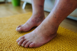 Early Attention Matters for Diabetic Foot Care