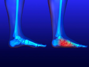 Understanding Overpronation