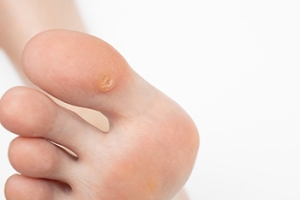 Plantar Warts and How to Prevent Them