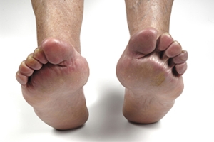 Rheumatoid Arthritis and Foot Swelling
