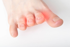 Can Morton&#039;s Neuroma Go Away?
