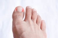 Treatment for Ingrown Toenails