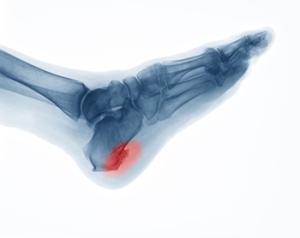 What Can Cause A Heel Spur?