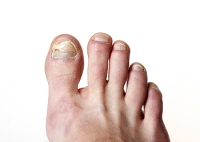 Causes of Thick Toenails