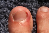 Treatment for Ingrown Toenails