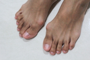 What Is Hallux Valgus?