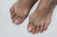 What Is Hallux Valgus?