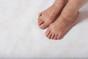 Understanding Hammertoes and How They Are Treated