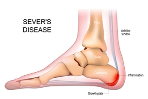 Affected Age Groups and Symptoms of Sever’s Disease