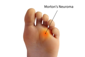 What Is Morton&#039;s Neuroma?