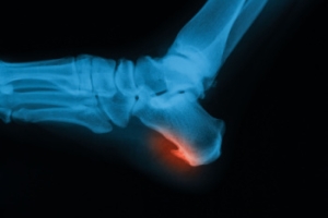 Types of Bone Spurs in the Feet