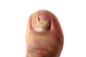 Recognizing and Treating Toenail Fungus Effectively