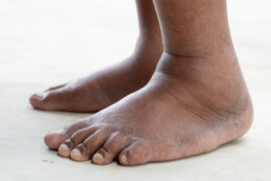 Common Causes of Swollen Ankles